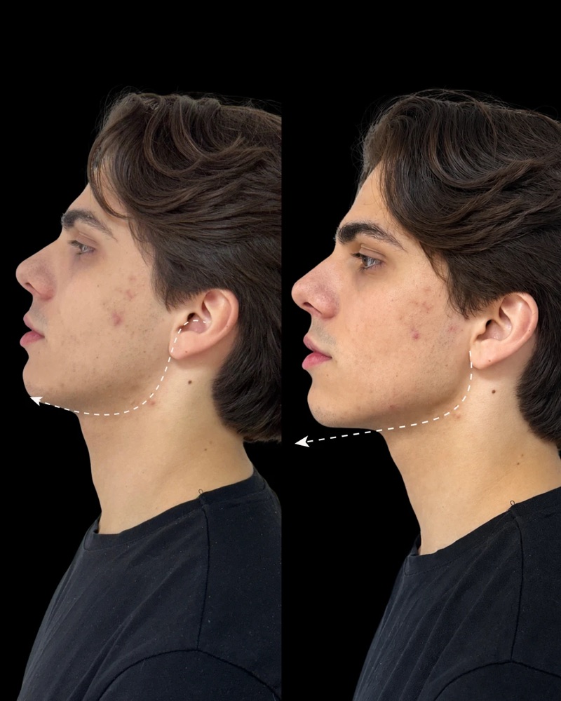 Antes e depois: Contorno mandibular · perfil