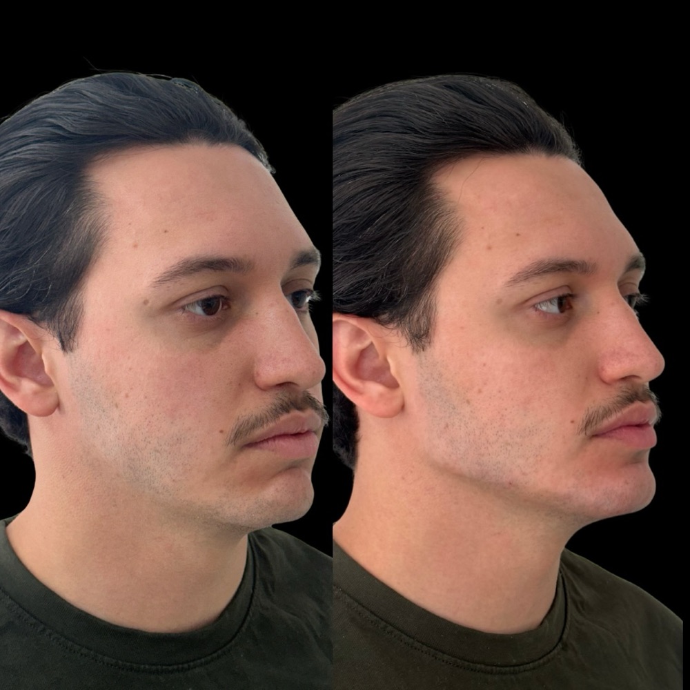 Antes e depois: Mandíbula e mento