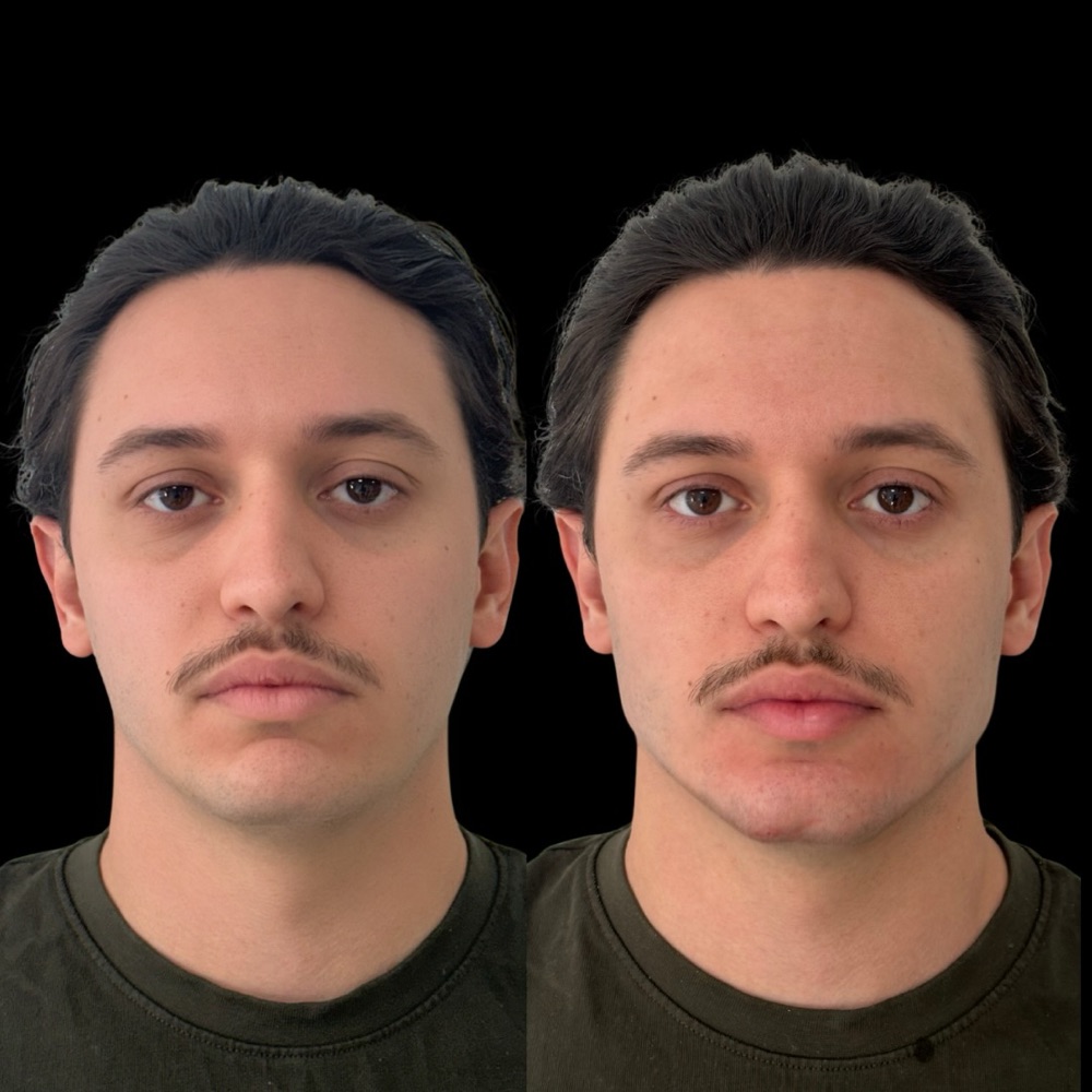 Antes e depois: Mandíbula e mento · frontal