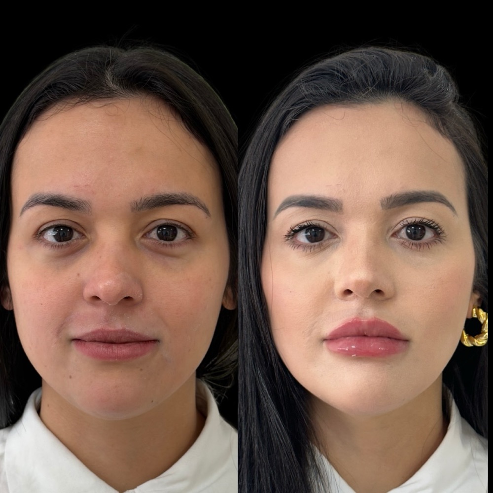 Antes e depois: Harmonização facial