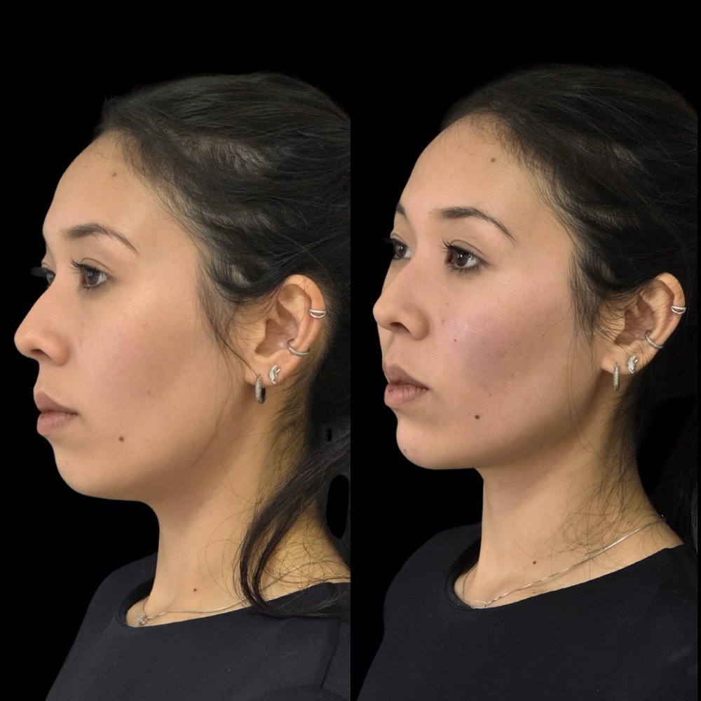 Antes e depois: Perfil e mento