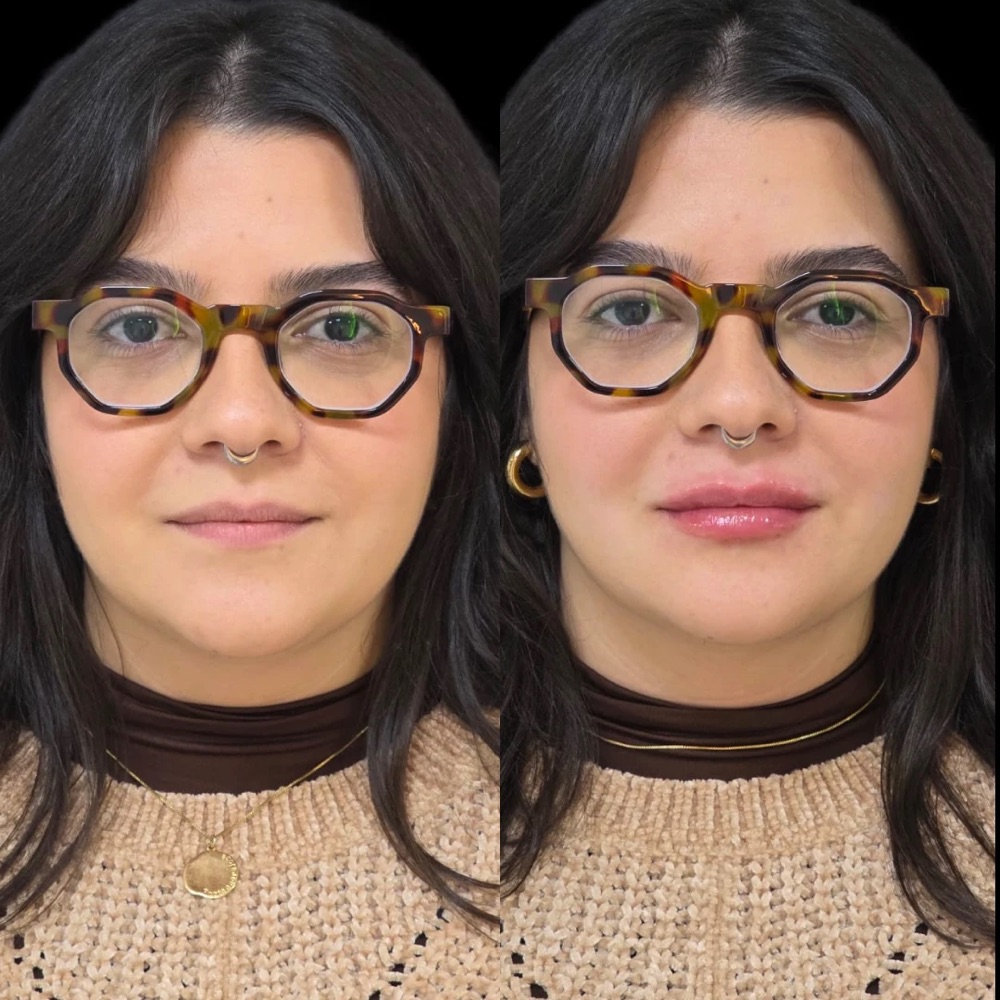Antes e depois: Lábios